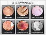 Termite Bite Symptoms Images