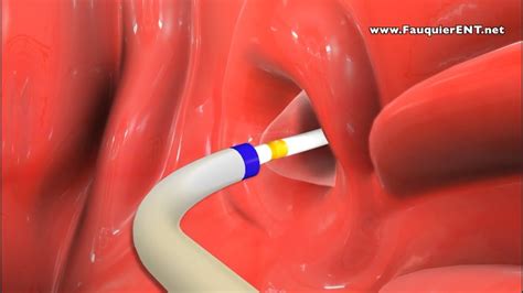 Eustachian tube dysfunction is fairly common in children, but more than 11 million adults in the united states also suffer from etd. Balloon Eustachian Tube Dilation to Treat Eustachian Tube Dysfunction - YouTube