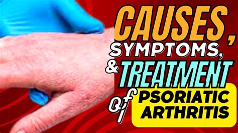 Psoriatic Arthritis Symptoms Causes And Treatment Youtube