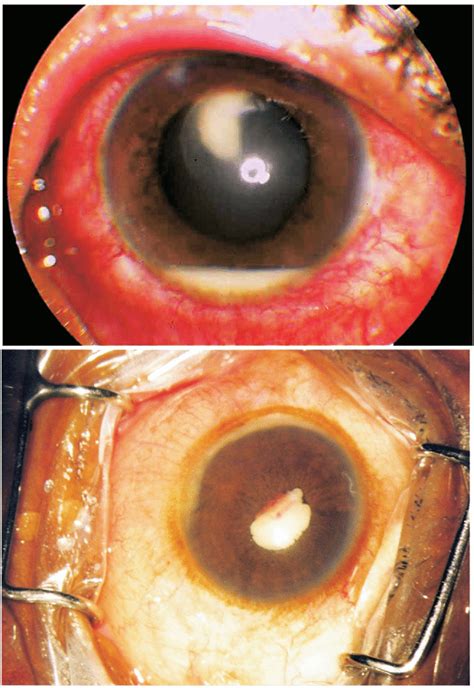 Figure Slit Lamp Photograph Of Traumatic Lens Abscess Showing The