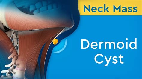 Neck Mass Dermoid Cyst Otosection