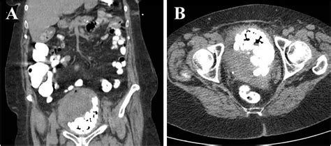 Squamous Cell Carcinoma Of The Bladder In A Female Associated With