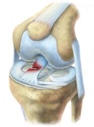 The sample acl includes an owner element that identifies the owner by the aws account's canonical. The ACL: The ACL (Anterior Cruciate Ligament) is one of t...