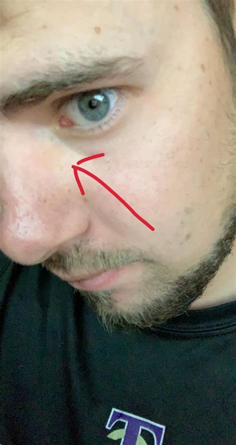 yellow spot on side of nose under eye what could it be not other symptoms have had this for