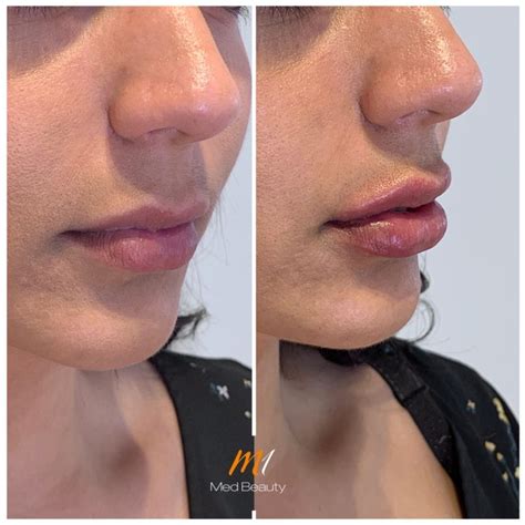 Before And After Treatment Pictures M1 Med Beauty Uk