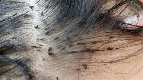 Pick Out A Thousand Head Lice From Black Hair How To Reduce A