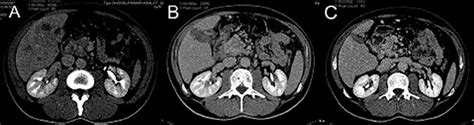 Sequence Of Images Of Contrast Enhanced Abdominal Ct Scan Late Phase