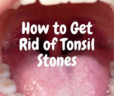 Tonsils Stones