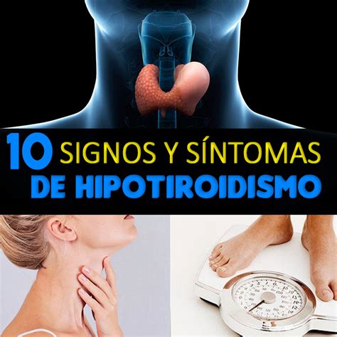 10 Signos Y Síntomas Del Hipotiroidismo La Guía De Las Vitaminas
