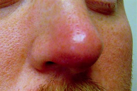 The Rudolph Sign Of Nasal Vestibular Furunculosis Questions Raised By