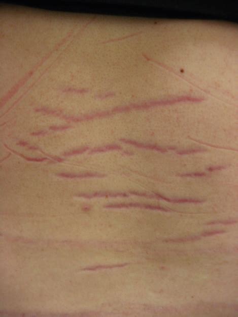 Horizontal Linear Streaks On A Healthy Teenagers Back Consultant360