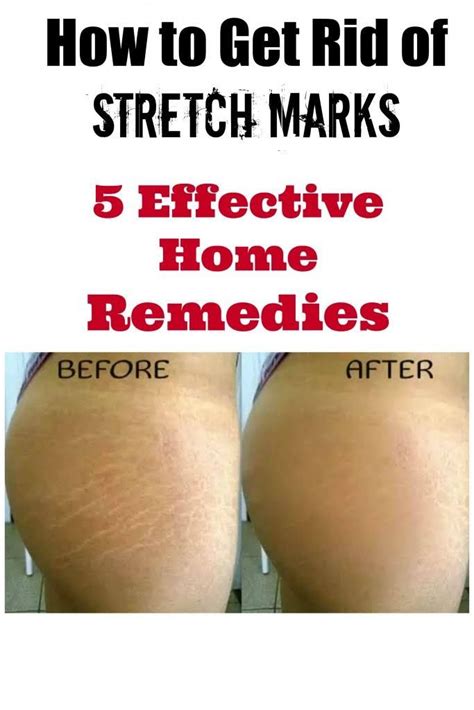 How To Get Rid Of Stretch Marks 5 Effective Home Remedies Stretch