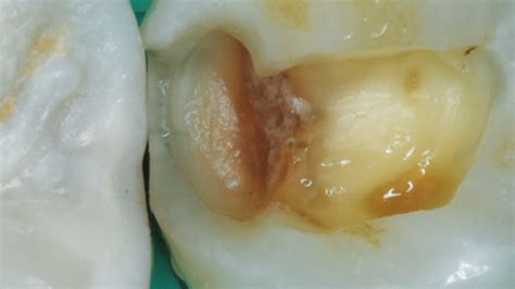 Clinical Treatment Of Deep Caries Decisions In Dentistry