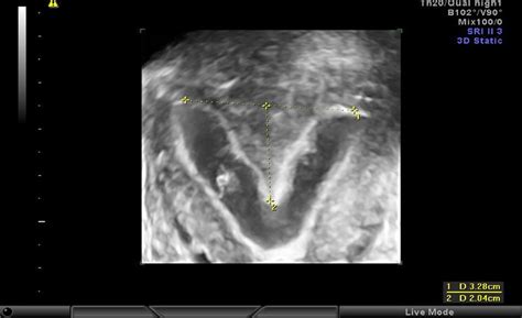 3 D SIS Demonstrating Uterine Septum Width 3 28 Cm And Depth Of 2 04