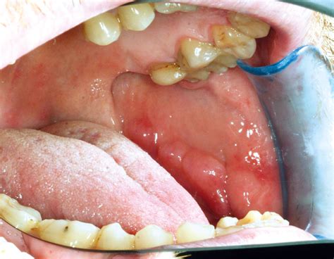 Diagnostics Of Oral Mucosae Den Norske Tannlegeforenings Tidende