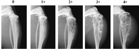 Radiographic Grading Scheme Varying Degrees Of Bony Lysis In The Tibia