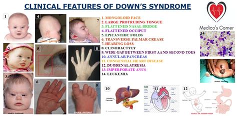 Clinical Features Of Down Syndrome Neet Pg Medicaltalknet The