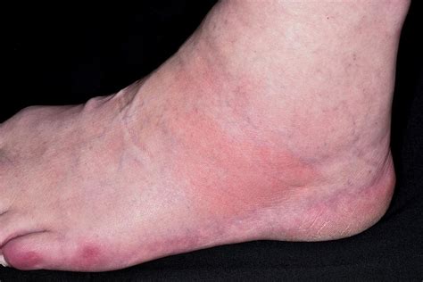 Gout Foot Swelling Gout Healer