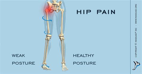 What Causes Hip Pain Mass4d Insoles Mass4d Foot Orthotics