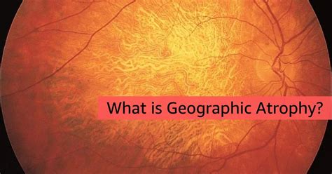 What Is Geographic Atrophy Board Certified Eye Doctors Burlington