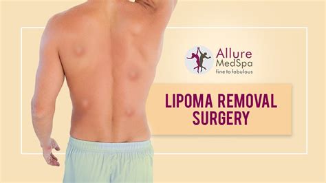 Lipoma Removal Multiple Lipoma Removal Surgery At Alluremedspa Youtube