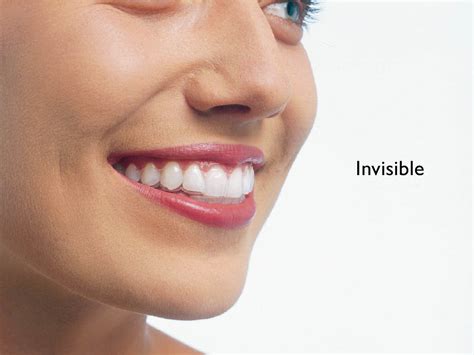 Invisible Braces Invisalign Dr Hassan El Awours Dental Office