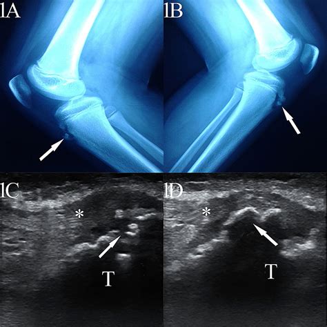 Osgood Schlatter Ultrasound Images