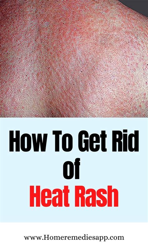 How To Get Rid Of Prickly Heat Heat Rash 2021 In 2021 Heat Rash