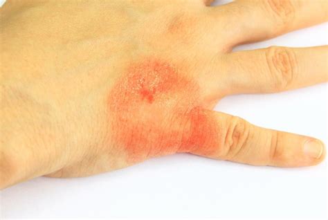 What Is A Food Allergy Rash With Pictures