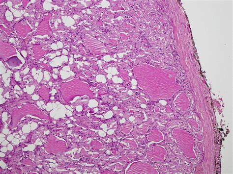 Pathology Outlines Amyloid Goiter