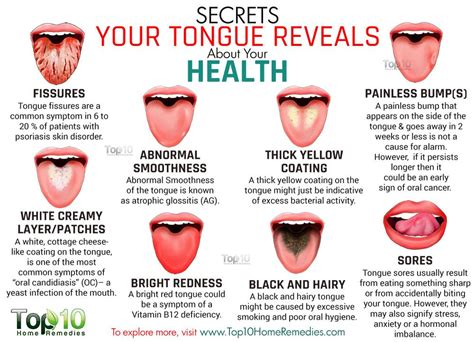 Glycerin can also be used on any burning white spot on tongue to ease the pain and facilitate the process of healing. 10 Secrets Your Tongue Reveals about Your Health | Top 10 ...