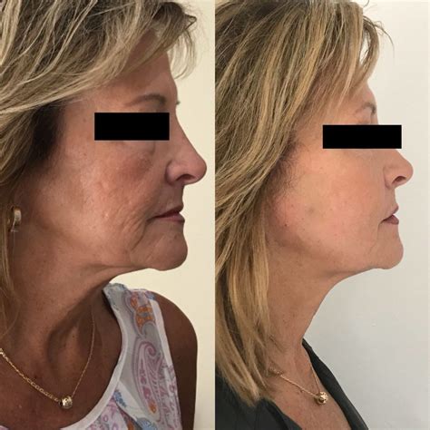 Non Surgical Facelift Threading Skin Works Medical Spa Torrance Ca