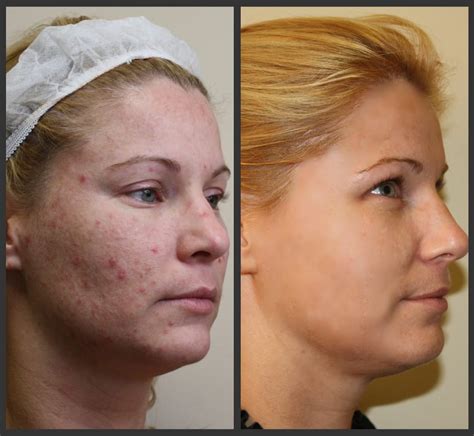 Before And After Isolaz And Fraxel Acne Laser Treatments Yelp