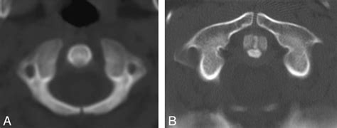 Normal Ossification Patterns Of Atlas And Axis A Ct Study American