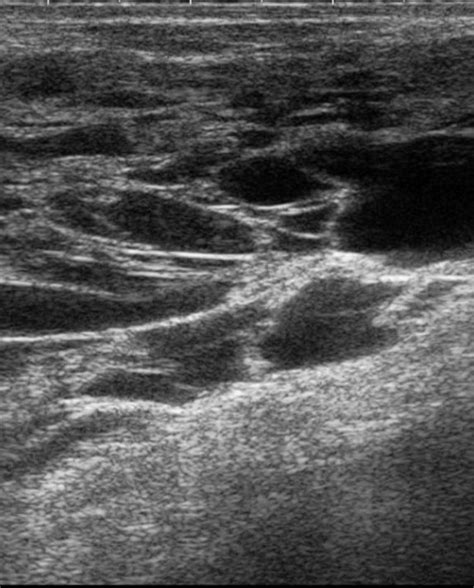 Ultrasound Of The Left Breast Showing Multiple Cystic Lesions