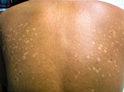 Pityriasis Versicolor What Is It Symptoms And Treatment Mediologiest The Best Porn Website