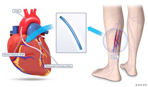 Coronary Artery Bypass Graft Assessment Of Coronary