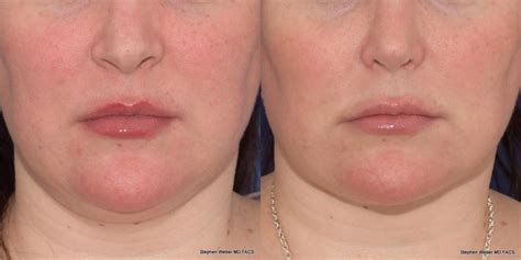 Buccal Fat Pad Removal Before And After 03 Weber Facial Plastic Surgery