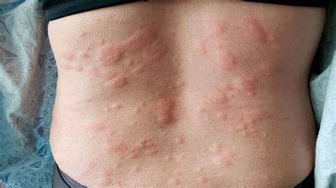 Common Causes Of Rashes And How To Alleviate Them Husband Info