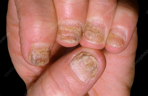 Psoriasis Of The Fingernails Stock Image C0372757 Science Photo