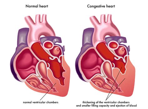 What Is Congestive Heart Failure University Health News