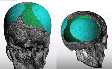 Plastic Surgery Case Study Secondary Custom Skull Implant Overlays