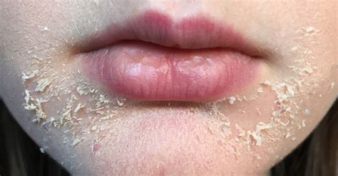 Dry Red Flaky Skin On Upper Lip