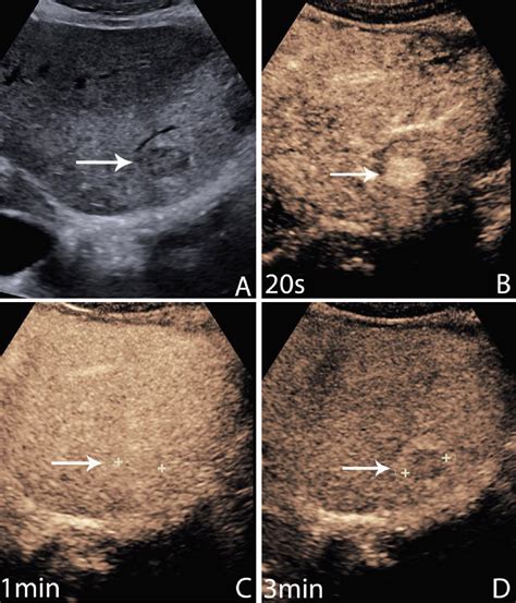 Contrast Enhanced Ultrasound Of Focal Liver Masses
