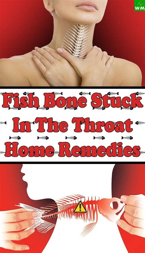 Severe cases can lead to choking episodes, breathing problems, malnutrition and dehydration. Getting a fish bone stuck in the throat can be a daunting ...