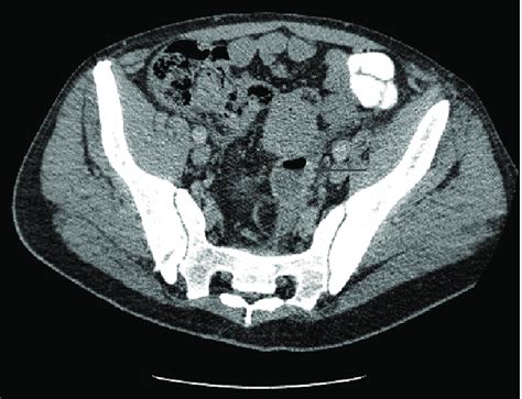 Cross Sectional Ct Scan Showing A Paracolic Diverticular Abscess Of The