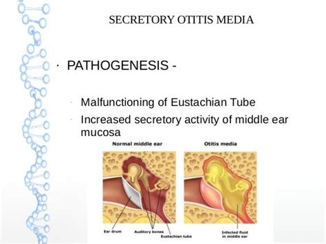 Pathophysiology Of Otitis Media