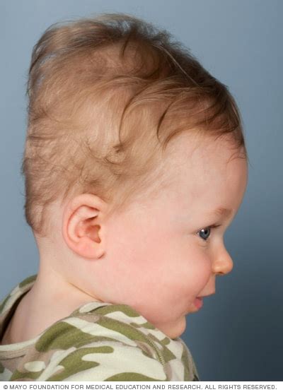 Babys Head Shape Cause For Concern Mayo Clinic