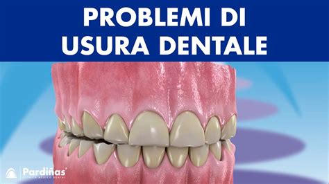 EROSIONE Smalto Denti ABRASIONE Dentale ABFRAZIONE E Altri Problemi