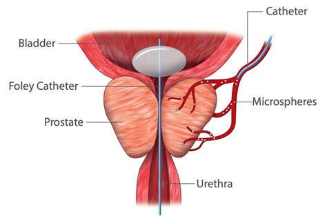 Prostatic Artery Embolization A Minimally Invasive Treatment For BPH